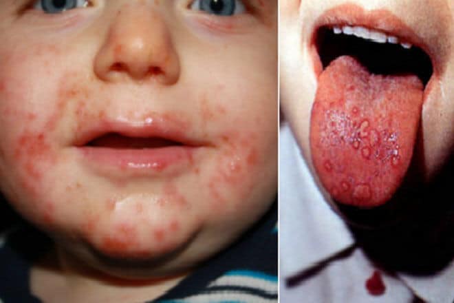 Спалах хвороби Коксакі на Київщині: що потрібно знати