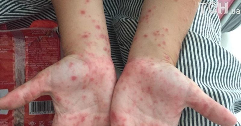 Спалах хвороби Коксакі на Київщині: що потрібно знати