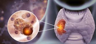 Чому зростає рак щитоподібної залози: головні причини