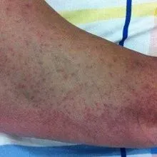 Небезпечний вірус чікунгунья в Європі: де ризик найвищий, які симптоми та як захиститися