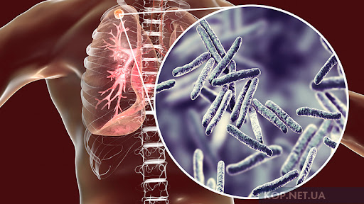 День боротьби з туберкульозом 24 березня — які симптоми небезпечні і коли йти до лікаря